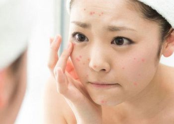 Bạn có biết loại serum giúp giảm mụn này đang nằm trong list yêu thích của nhiều bạn trẻ?