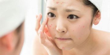 Bạn có biết loại serum giúp giảm mụn này đang nằm trong list yêu thích của nhiều bạn trẻ?