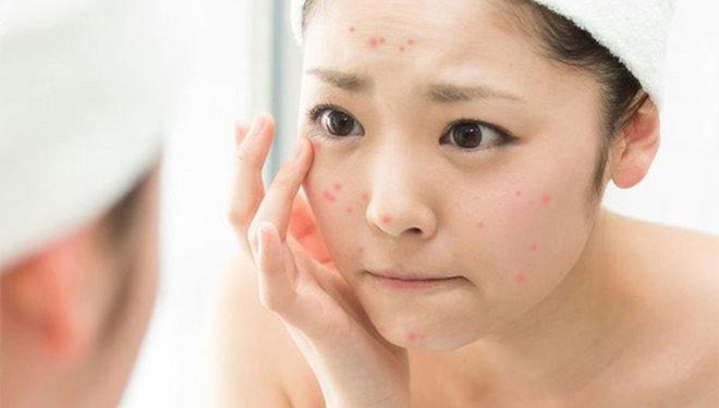 Bạn có biết loại serum giúp giảm mụn này đang nằm trong list yêu thích của nhiều bạn trẻ?
