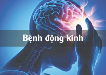 Bệnh Động Kinh và những điều cần biết