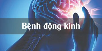 Bệnh Động Kinh và những điều cần biết