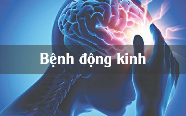 Bệnh Động Kinh và những điều cần biết