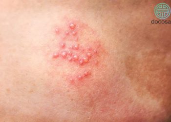 Bệnh zona thần kinh là gì? Có cần gặp bác sĩ không?