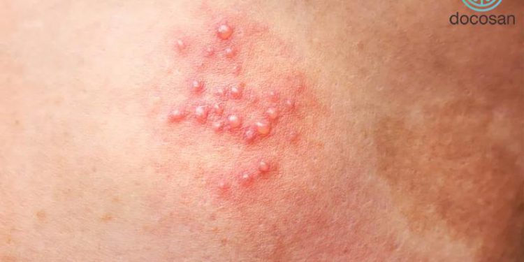 Bệnh zona thần kinh là gì? Có cần gặp bác sĩ không?