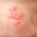 Bệnh zona thần kinh là gì? Có cần gặp bác sĩ không?