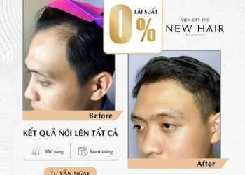 4 Yếu Tố Ảnh Hưởng Đến Sự “Lâu Dài” Sau Khi Cấy Tóc