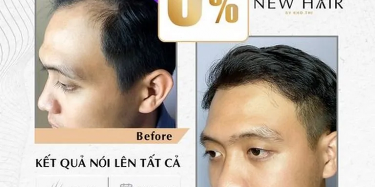 4 Yếu Tố Ảnh Hưởng Đến Sự “Lâu Dài” Sau Khi Cấy Tóc