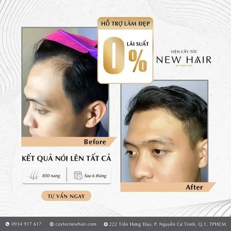 4 Yếu Tố Ảnh Hưởng Đến Sự “Lâu Dài” Sau Khi Cấy Tóc