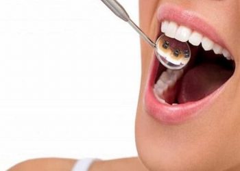 Niềng răng thẩm mỹ là gì? Địa chỉ niềng răng thẩm mỹ uy tín nhất 2022