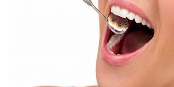 Niềng răng thẩm mỹ là gì? Địa chỉ niềng răng thẩm mỹ uy tín nhất 2022