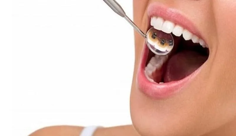Niềng răng thẩm mỹ là gì? Địa chỉ niềng răng thẩm mỹ uy tín nhất 2022